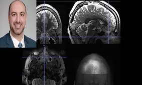 سینوزیت مزمن باعث ایجاد تغییر در فعالیت مغز می‌شود