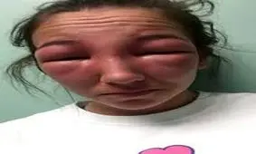 بلای وحشتناکی که بوتاکس بر سر چهره این زن آورد