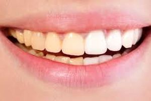 این عادت‌های غلط دندان‌های شما را زرد می‌کند