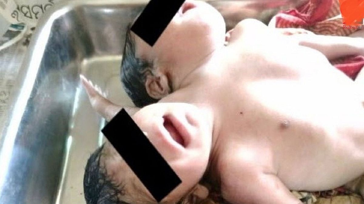 تولد نوزادی با 2 سر و 3 دست