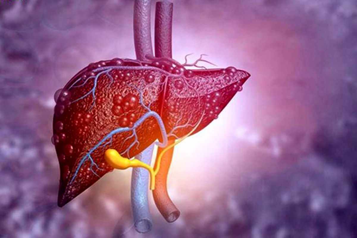 کبد چرب در زنان؛ این نشانه‌ها را جدی بگیرید