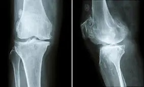 عوارض کمبود کلسیم برای بدن