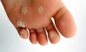 درمان زخم پای دیابتی با دانش ایرانی/ تجاری‌سازی ۴ نسل از دستگاه نوار قلب