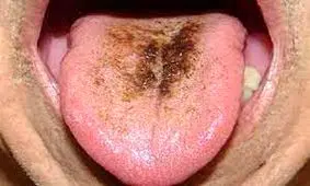 ۷ دلیل احتمالی ایجاد لکه‌های تیره بر روی زبان