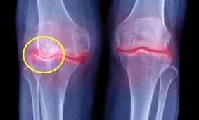 آسیب‌های مفصلی ناشی از اضافه وزن یکی از اثرات شیوع کروناست