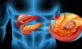 مبارزه با سرطان پانکراس با کشف یک مسیر مولکولی جدید