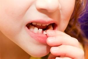 مراقب دندان‌های کودکان باشید!
