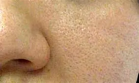 روش‌هایی برای بسته شدن منافذ پوست