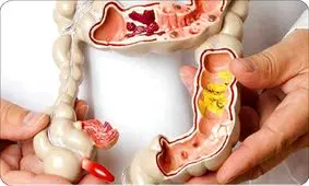 پارگی روده پیامد چسبندگی درمان نشده