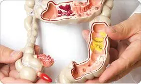 پارگی روده پیامد چسبندگی درمان نشده