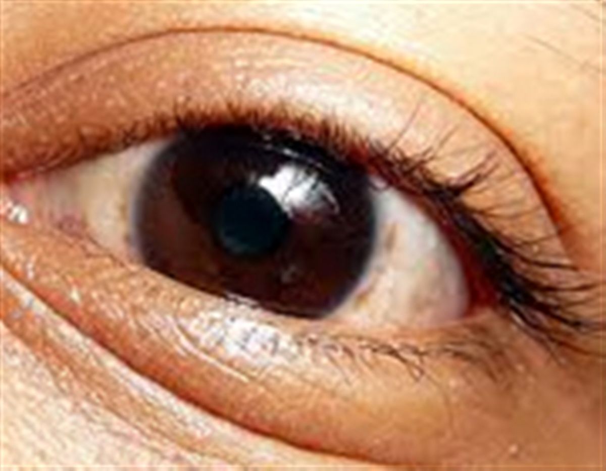 عوامل تولیدکننده کیسههای زیر چشم و روشهای کاهش آن