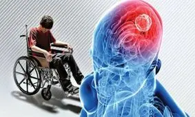 راهکاری برای کاهش لرزش در بیماران مبتلا به "ام اس"