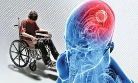 راهکاری برای کاهش لرزش در بیماران مبتلا به "ام اس"