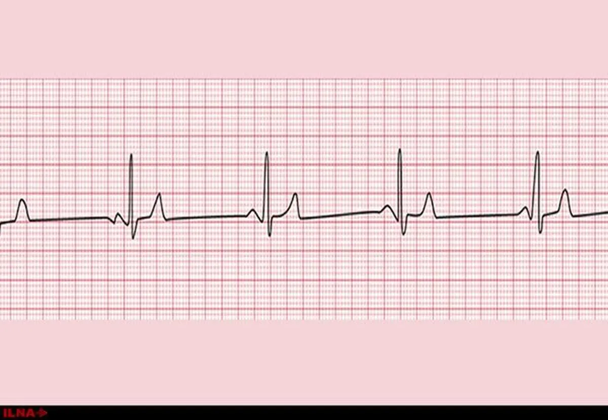 عمل آنژویوگرافی حجت‌الاسلام کروبی به پایان رسید/ انتقال کروبی به بخش مراقبت‌های ویژه