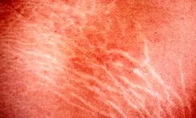 آشنایی با سلولیت و راهکارهای مبارزه با آن