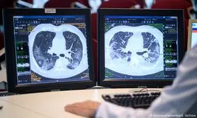 تولید داروی بهبود علایم ریوی برای بیماران مبتلا به کرونا