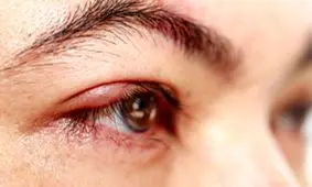 نوعی سرطان نادر چشم و امیدواری برای درمان آن