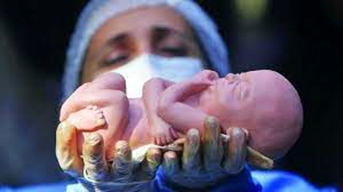 غربالگری جنین و سقط درمانی روی میز نقد وکلا و پزشکان