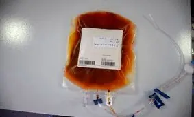 اهدای اولین سلول‌های مغز استخوان غیر خویشاوندی در تبریز 