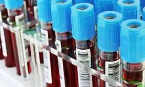 تشخیص زودهنگام آلزایمر با مطالعه روی پروتئین‌های خون