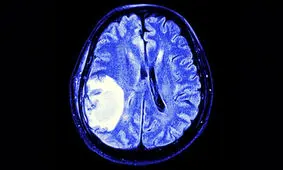 مبارزه با تومور مغزی با دستکاری سلول‌های ایمنی فلج شده