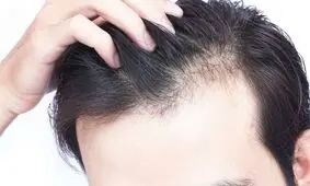 ریزش موی ناشی از ویروس کرونا دائمی نیست