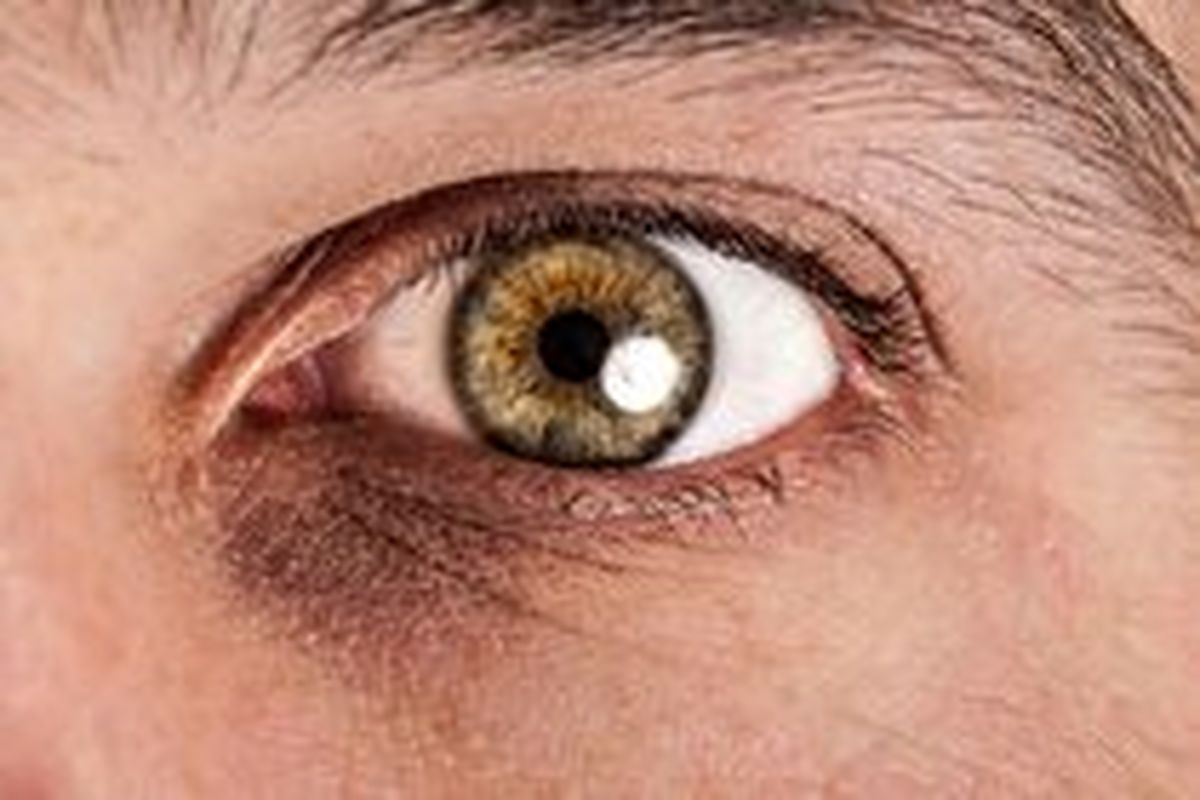 سیاهی دور چشم نشانه چیست؟
