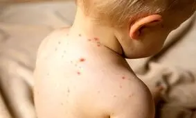 پشت پرده شیوع بیماری سرخک در البرز/ ماجرای گسترش یک بیماری خطرناک در کرج چیست؟
