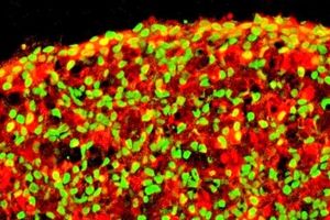 گامی مهم در درمان دیابت نوع ۱ با کمک سلول‌های بنیادی