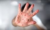 تاکنون موردی از ابتلا به سرخک در خراسان جنوبی نداشته‌ ایم