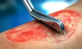 راهکاری برای بهبود سریع زخم دیابتی