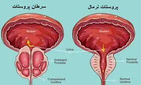 بررسی ارتباط احتمالی سرطان پروستات با یک اختلال روانی
