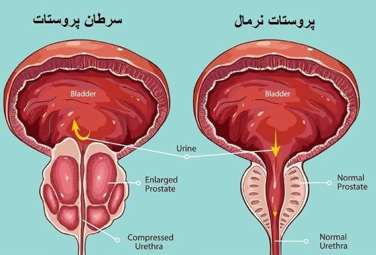 بررسی ارتباط احتمالی سرطان پروستات با یک اختلال روانی