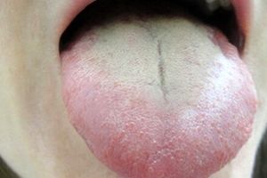 سفید شدن زبان زنگ خطر این بیماری‌هاست