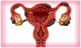 تاثیر تستوسترون پایین بر افزایش خطر ابتلا به آندومتریوز