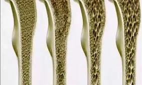 بیماری عجیبی که زنان بیشتر در معرض آن قرار دارند