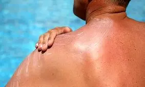 کدام قسمت‌های بدن از آفتاب‌سوختگی مصون نمی‌مانند؟