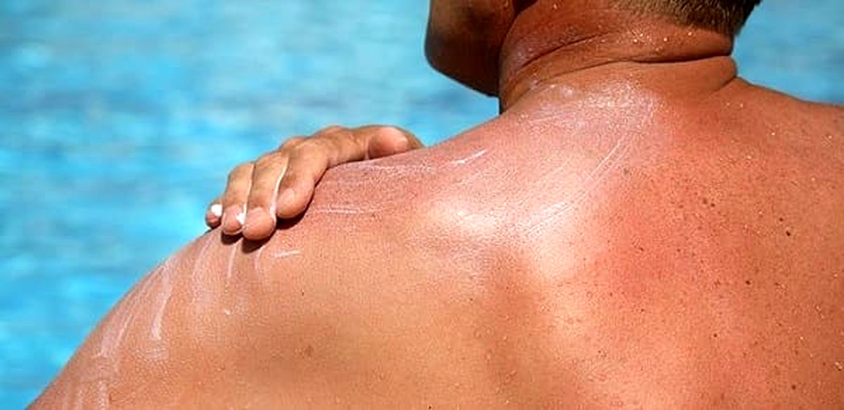 کدام قسمت‌های بدن از آفتاب‌سوختگی مصون نمی‌مانند؟