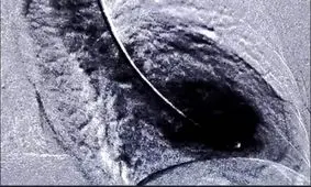 استرس بالا احتمال "سندرم قلب شکسته" را افزایش می دهد