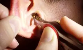 بیرون آوردن مهمان‌های ناخوانده از گوش!