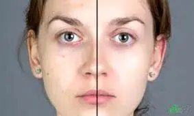 پنج نشانه کمبود ویتامین در صورت شما