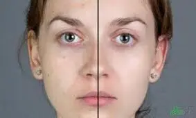 پنج نشانه کمبود ویتامین در صورت شما