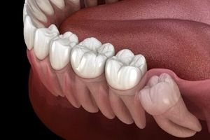 دندان عقل چگونه کشیده می‌شود؟/ ویدئو