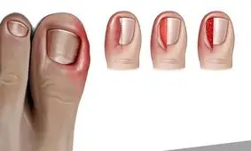 راه‌هایی برای جلوگیری از رشد ناخن در گوشت پا