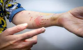 تاثیر پماد سنجد تلخ بر زخم‌های سوختگی