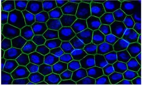 درمان یک اختلال نادر دوره کودکی با کمک سلول‌ های برنامه‌ ریزی شده