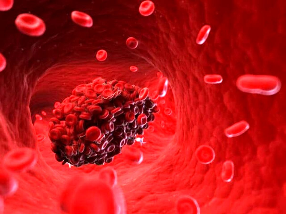 تشخیص بهتر "لخته خون" با یک روش جدید تصویربرداری