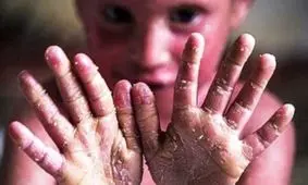 محموله پانسمان های بیماران پروانه ای در انبارهای وزارت بهداشت است/مفقودی پانسمانها صحت ندارد