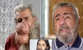 ایجاد توده بزرگ عجیب روی بینی مرد میانسال