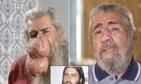 ایجاد توده بزرگ عجیب روی بینی مرد میانسال